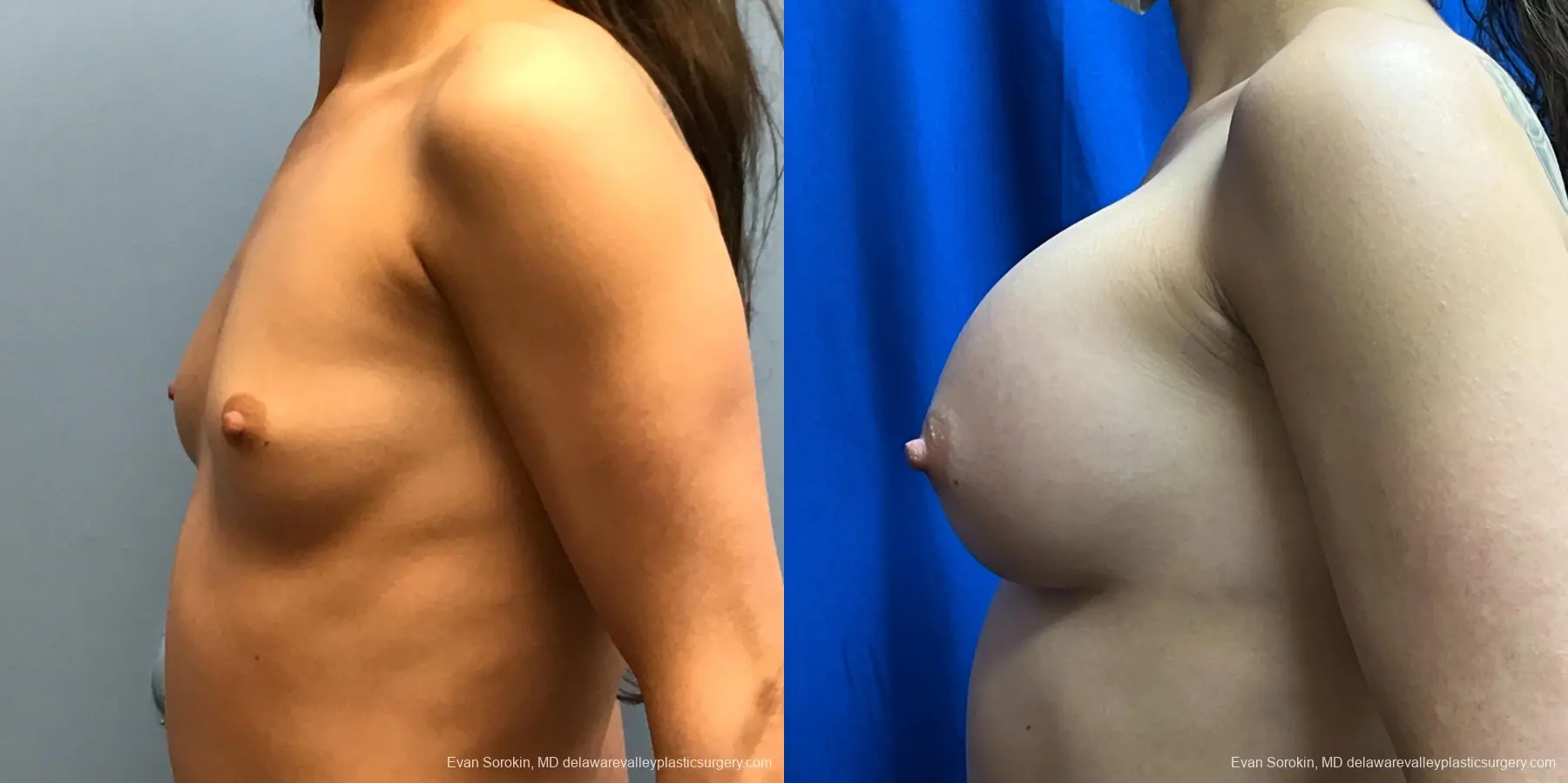 Breast Augmentation: Patient 229 - Before and After 5