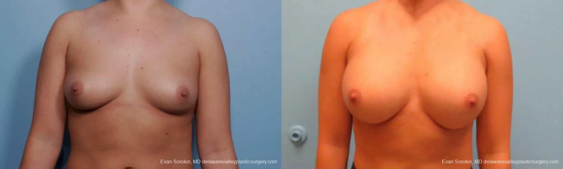 Philadelphia Breast Augmentation 9383 - Before and After 1