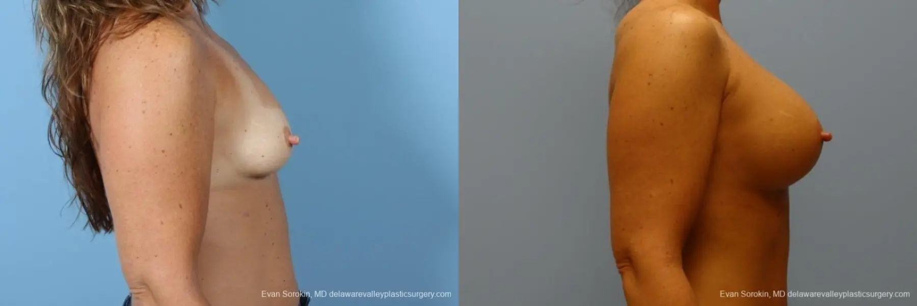 Philadelphia Breast Augmentation 8774 - Before and After 4