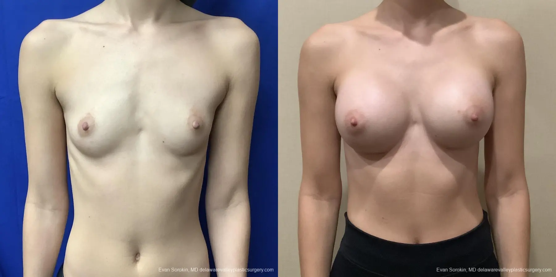 Breast Augmentation: Patient 210 - Before and After 1