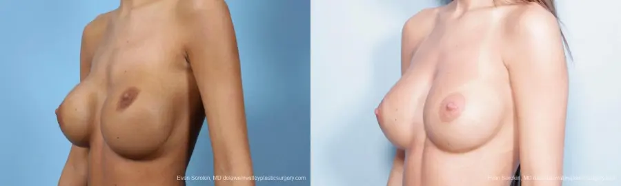 Philadelphia Breast Augmentation 9445 - Before and After 2