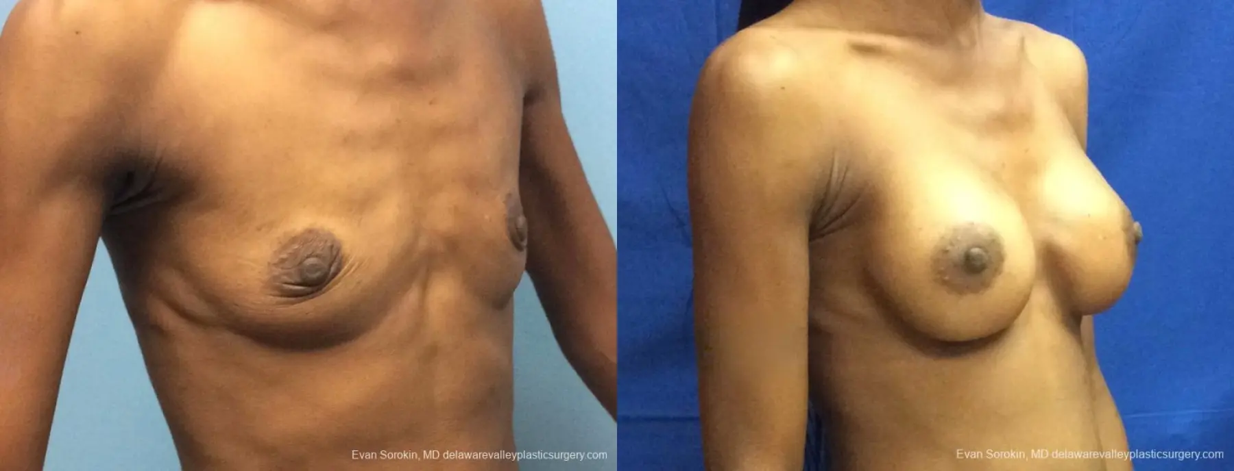 Philadelphia Breast Augmentation 13072 - Before and After 2
