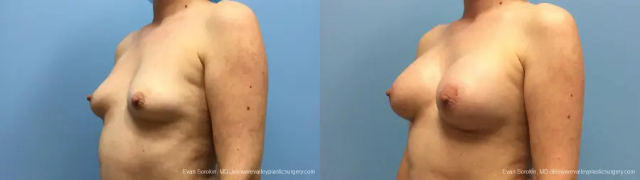 Philadelphia Breast Augmentation 13181 - Before and After 4