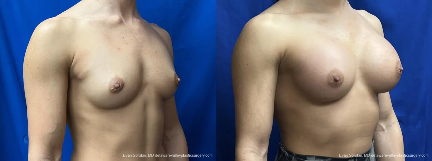 Breast Augmentation: Patient 202 - Before and After 2