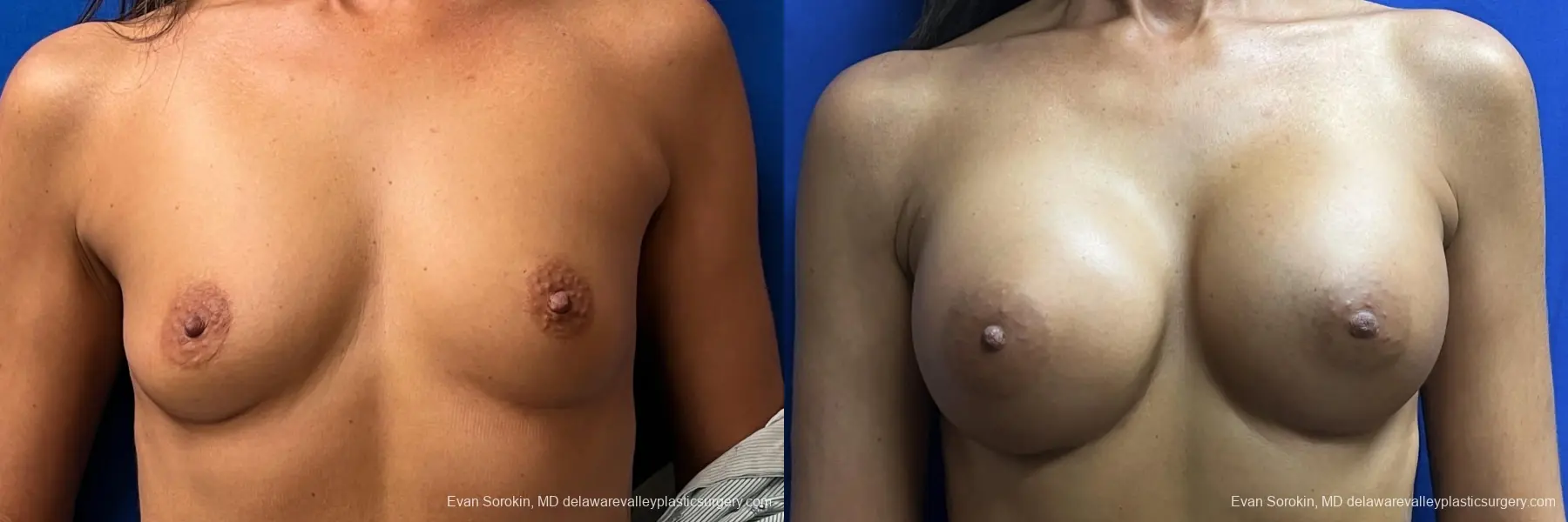 Breast Augmentation: Patient 10 - Before and After  