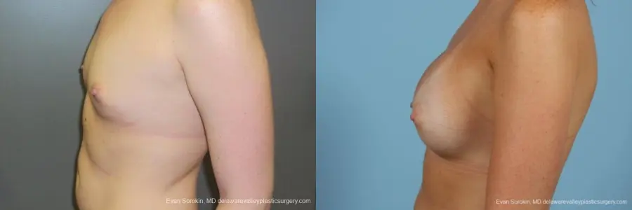 Philadelphia Breast Augmentation 8669 - Before and After 5