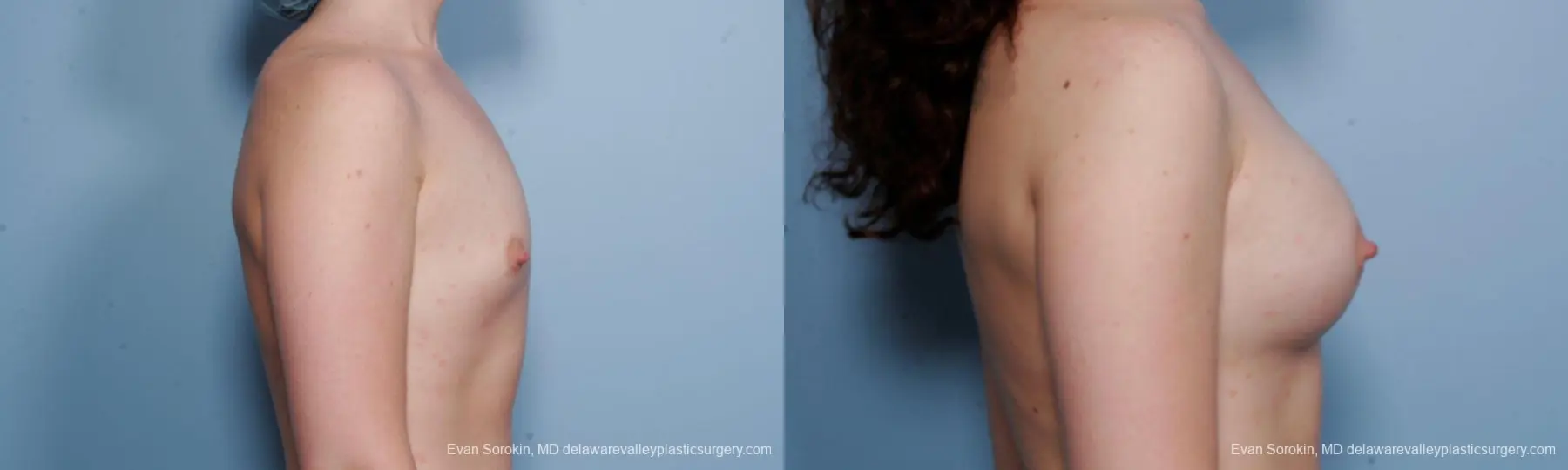 Philadelphia Breast Augmentation 9176 - Before and After 5