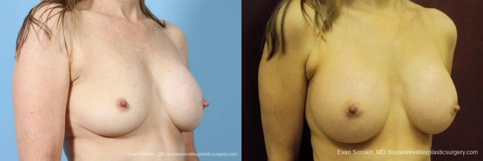 Philadelphia Breast Augmentation 8708 - Before and After 2