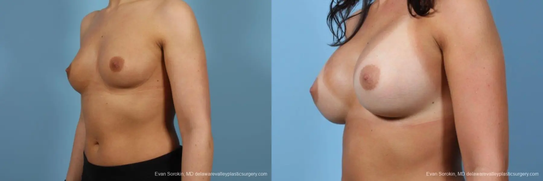 Philadelphia Breast Augmentation 8643 - Before and After 4