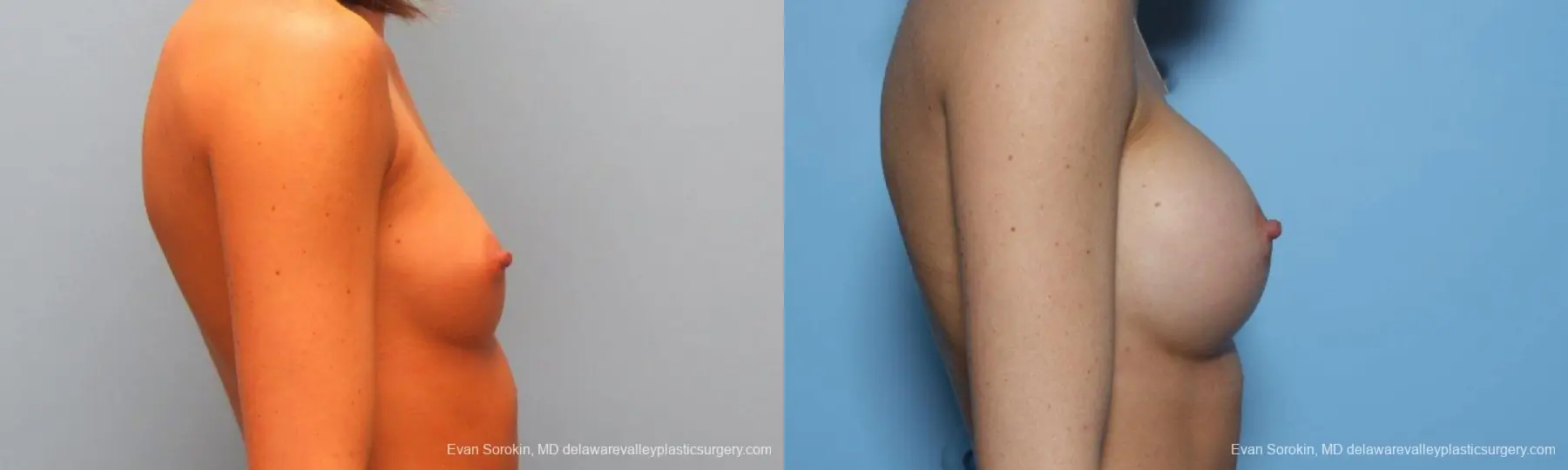 Philadelphia Breast Augmentation 9421 - Before and After 3
