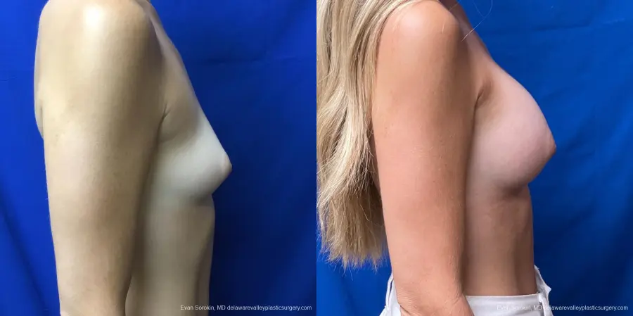 Breast Augmentation: Patient 171 - Before and After 3