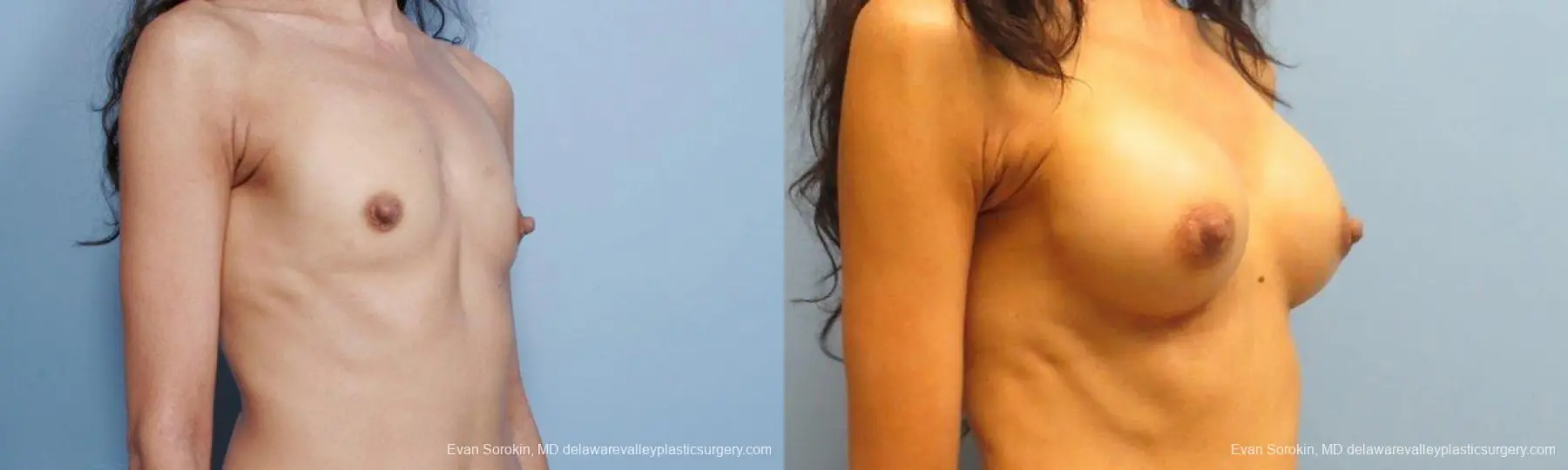 Philadelphia Breast Augmentation 9424 - Before and After 2