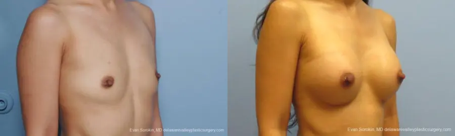 Philadelphia Breast Augmentation 8661 - Before and After 2