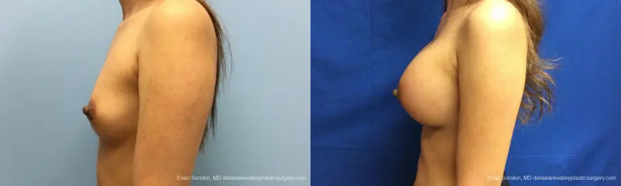 Philadelphia Breast Augmentation 12515 - Before and After 5