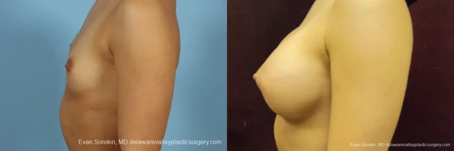 Philadelphia Breast Augmentation 9408 - Before and After 5