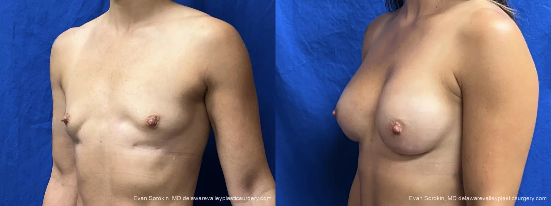 Breast Augmentation: Patient 309 - Before and After 3