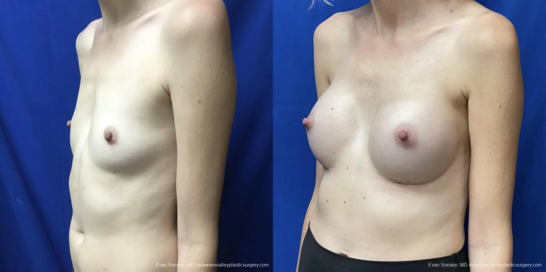 Breast Augmentation: Patient 174 - Before and After 4