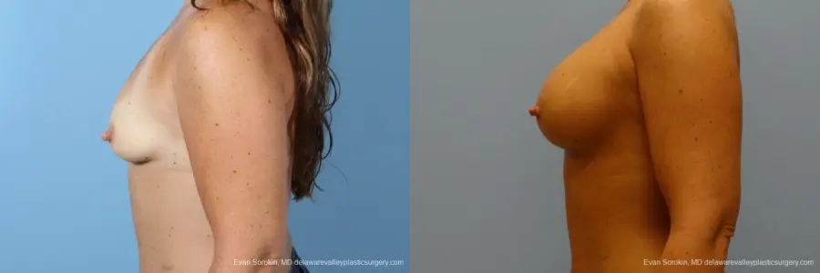 Philadelphia Breast Augmentation 8774 - Before and After 5