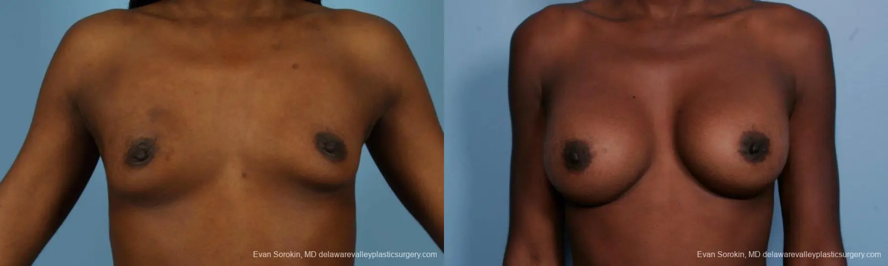 Philadelphia Breast Augmentation 8655 - Before and After 1