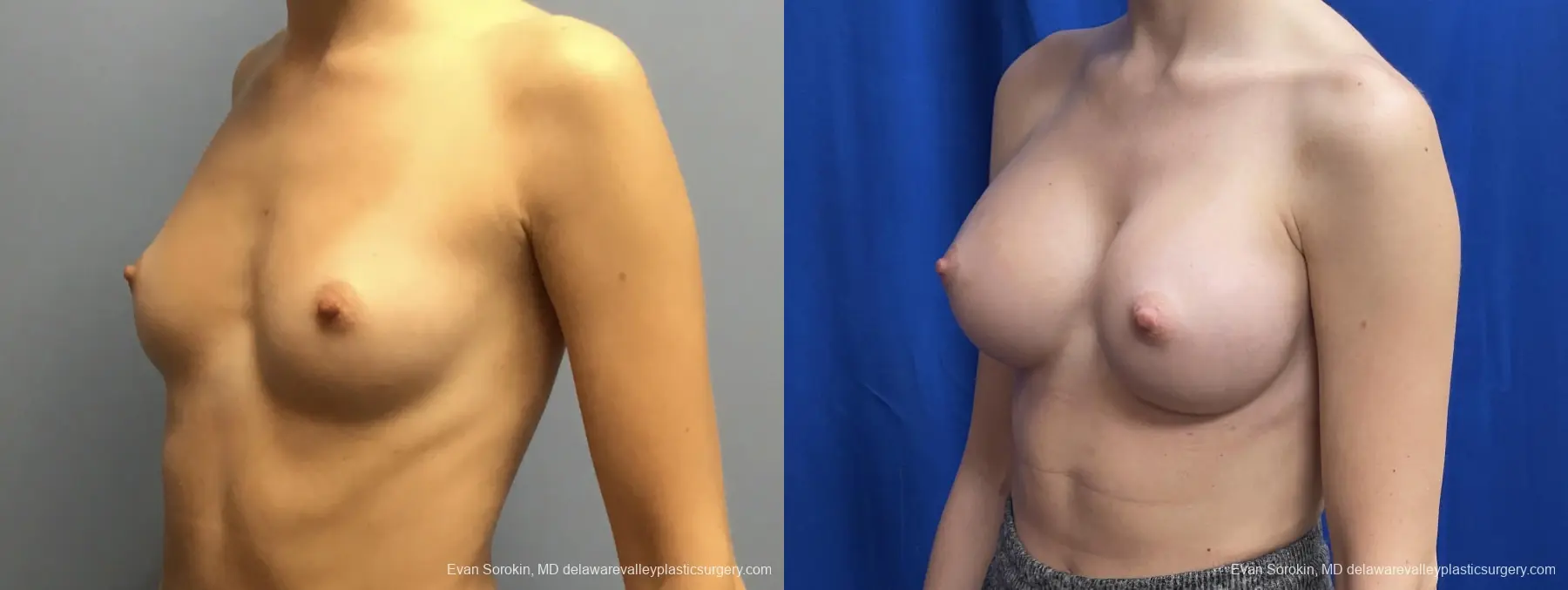 Breast Augmentation: Patient 201 - Before and After 4