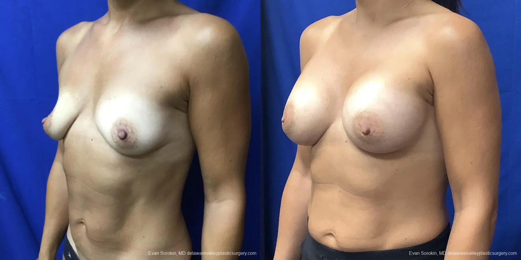 Breast Augmentation: Patient 220 - Before and After 4