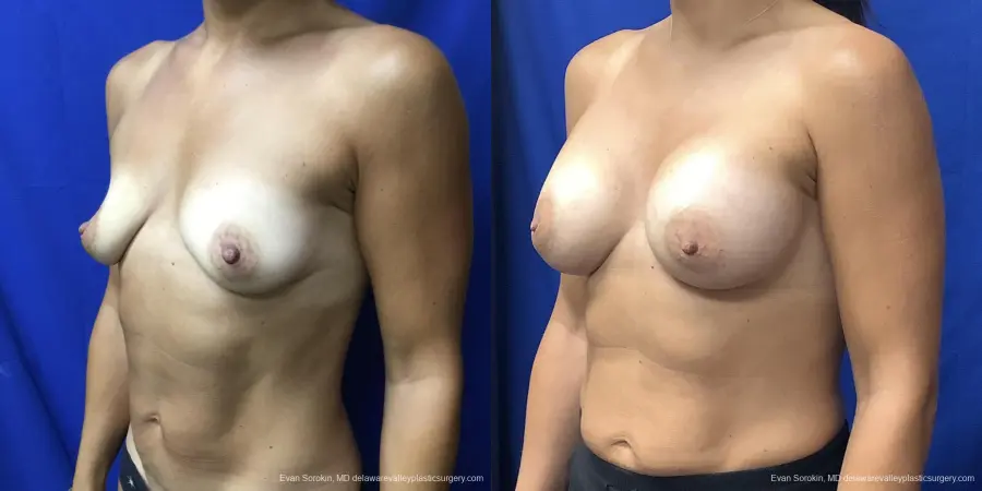 Breast Augmentation: Patient 187 - Before and After 4