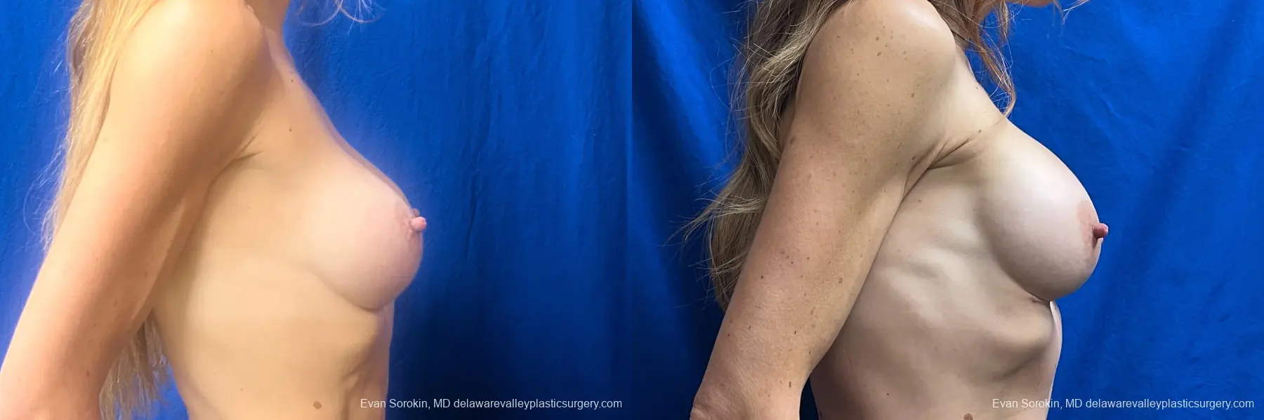 Breast Augmentation: Patient 279 - Before and After 3
