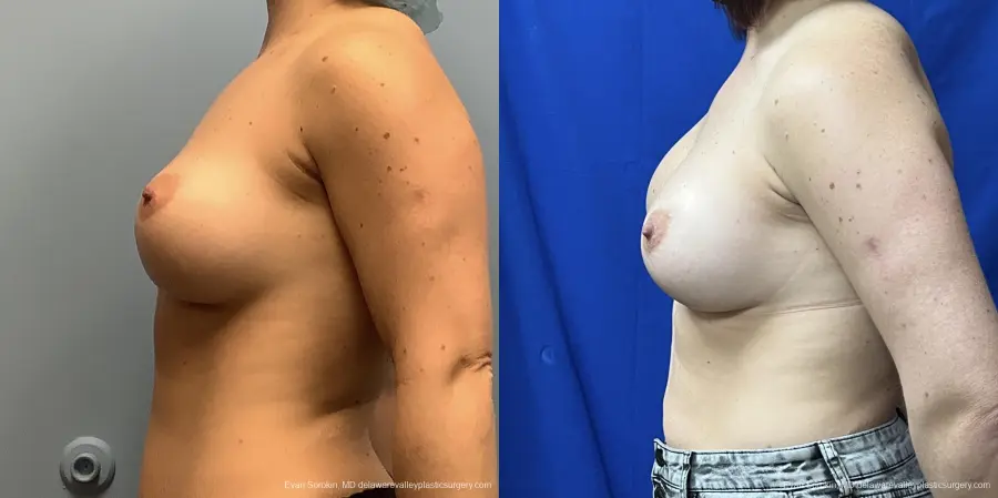 Breast Augmentation: Patient 224 - Before and After 3