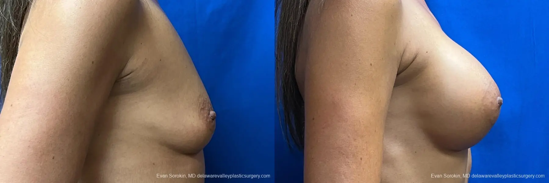 Breast Augmentation: Patient 10 - Before and After 3