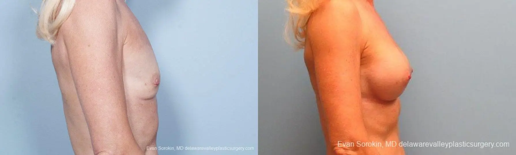 Philadelphia Breast Augmentation 9415 - Before and After 3
