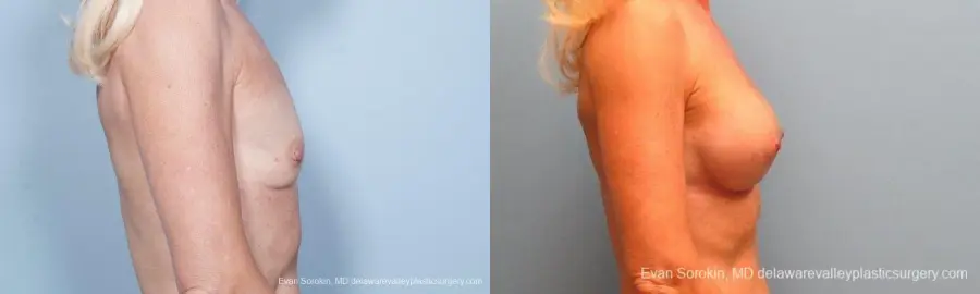 Philadelphia Breast Augmentation 9415 - Before and After 3