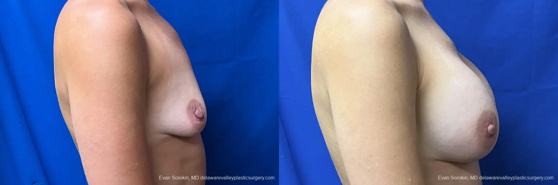 Breast Augmentation: Patient 203 - Before and After 3