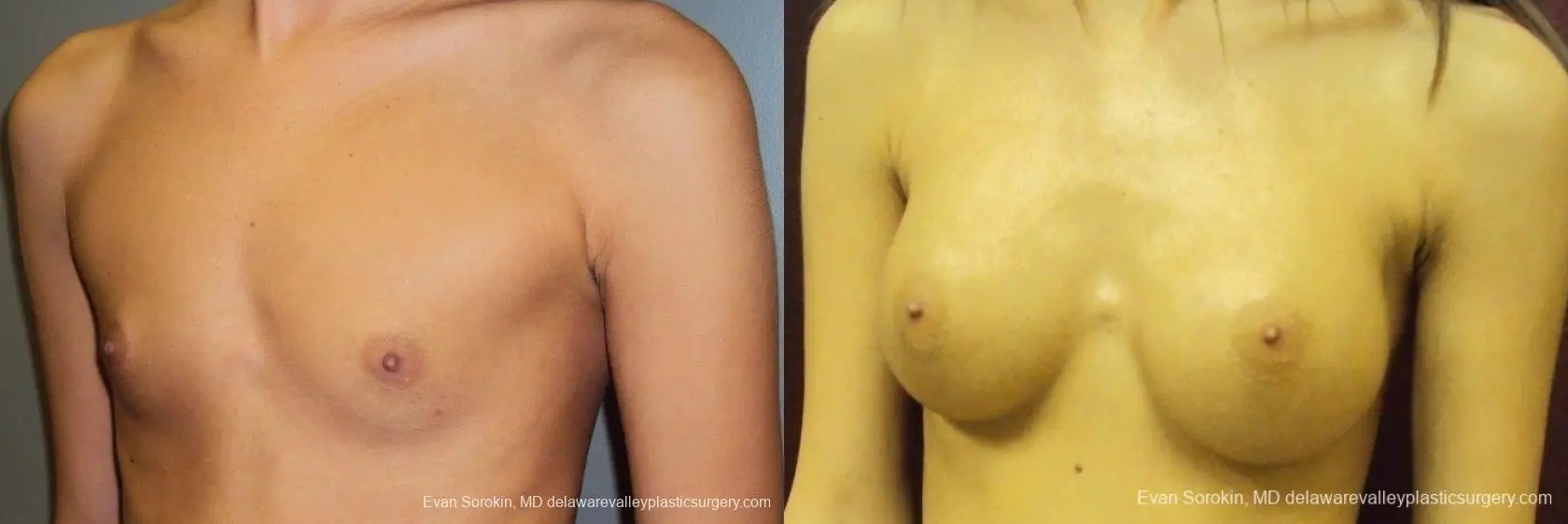 Philadelphia Breast Augmentation 8668 - Before and After 3