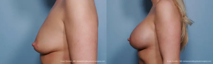 Philadelphia Breast Augmentation 9372 - Before and After 5