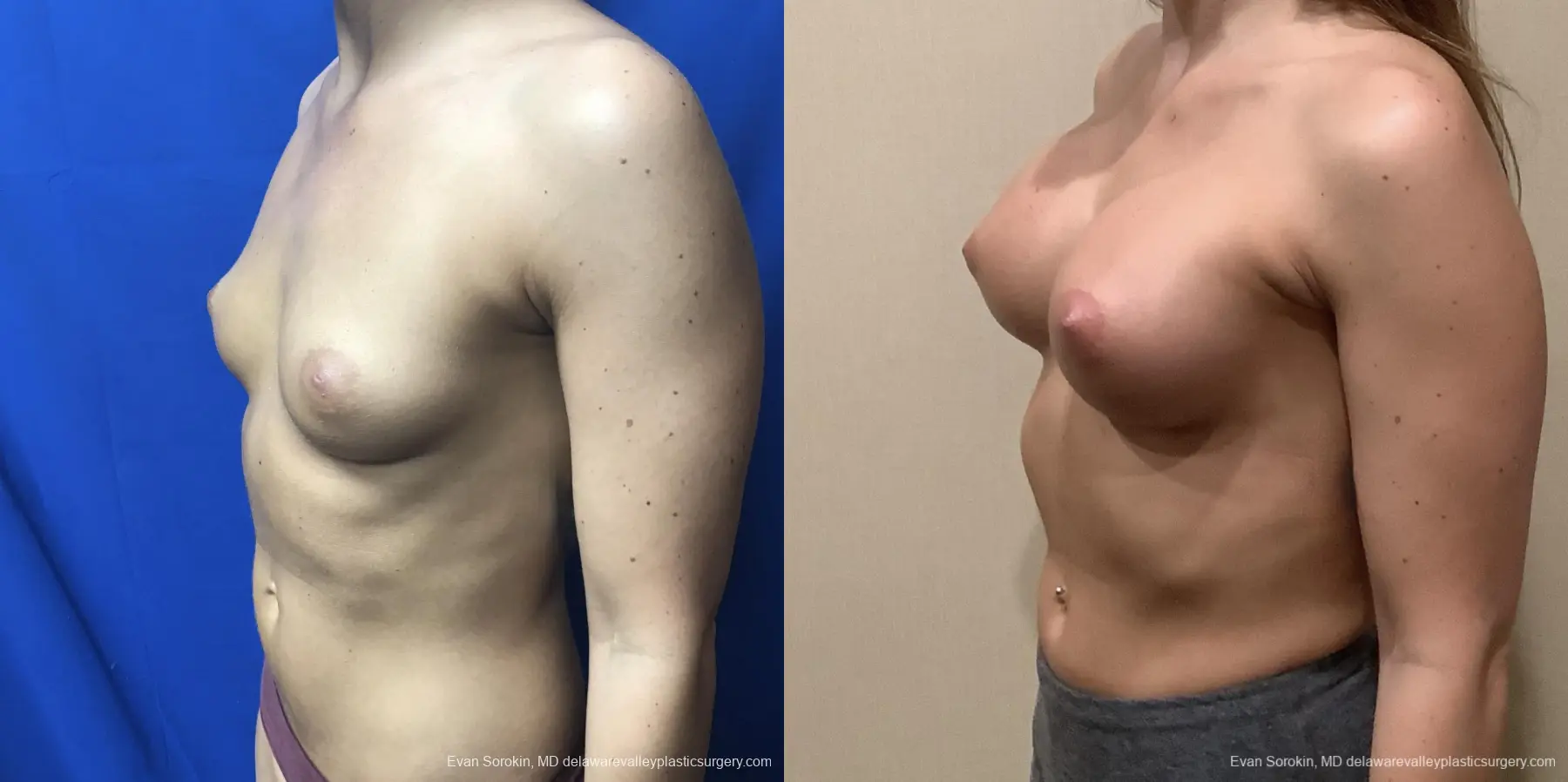 Breast Augmentation: Patient 186 - Before and After 4