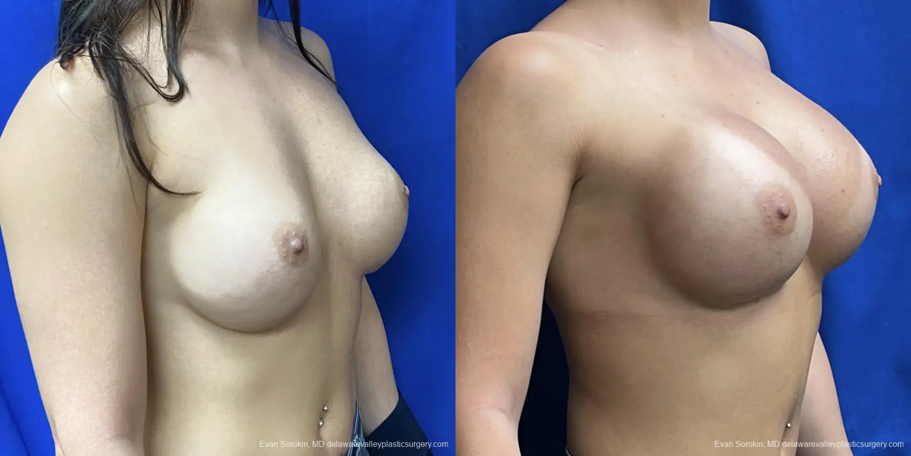 Breast Augmentation: Patient 256 - Before and After 2