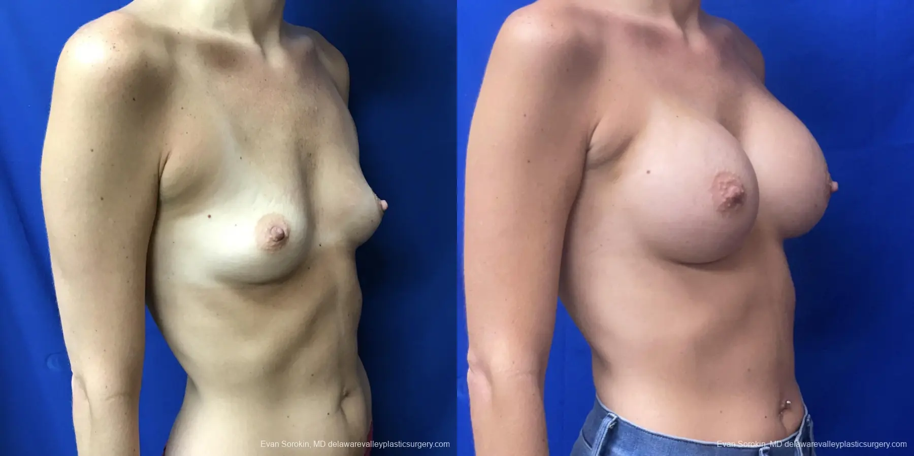 Breast Augmentation: Patient 184 - Before and After 2
