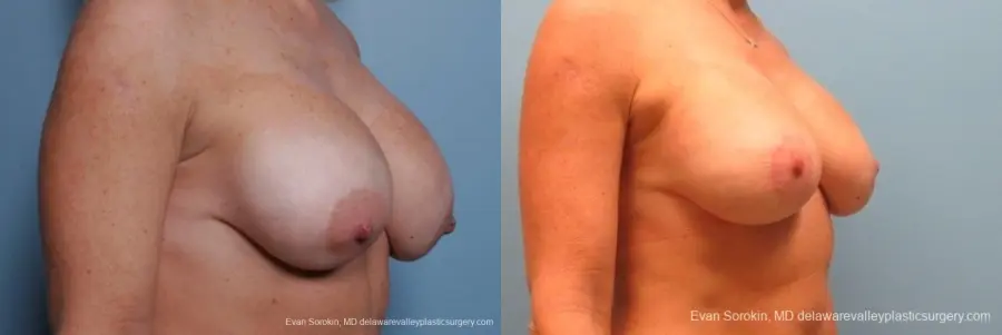 Philadelphia Breast Augmentation 8693 - Before and After 2