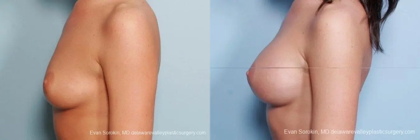 Philadelphia Breast Augmentation 8792 - Before and After 5