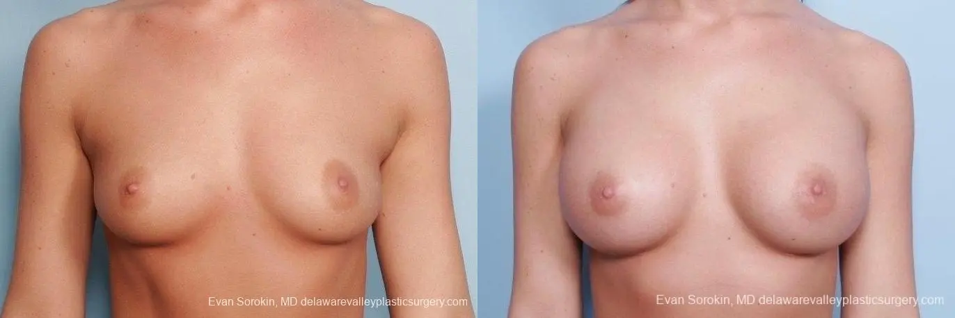 Philadelphia Breast Augmentation 8792 - Before and After 1