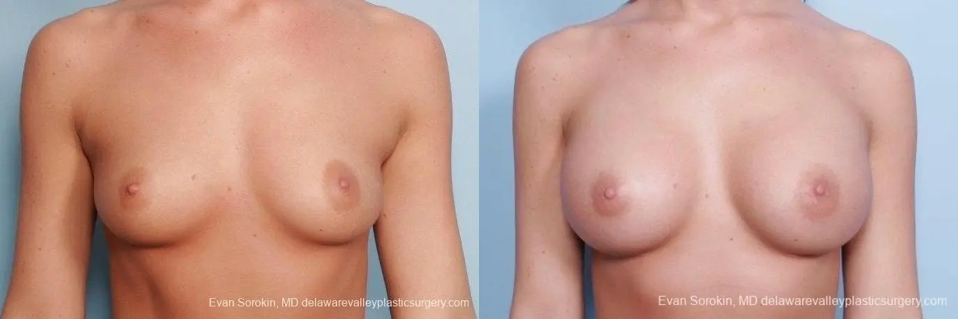 Philadelphia Breast Augmentation 8792 - Before and After