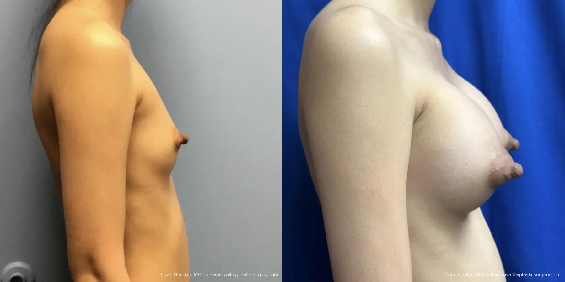 Breast Augmentation: Patient 251 - Before and After 3