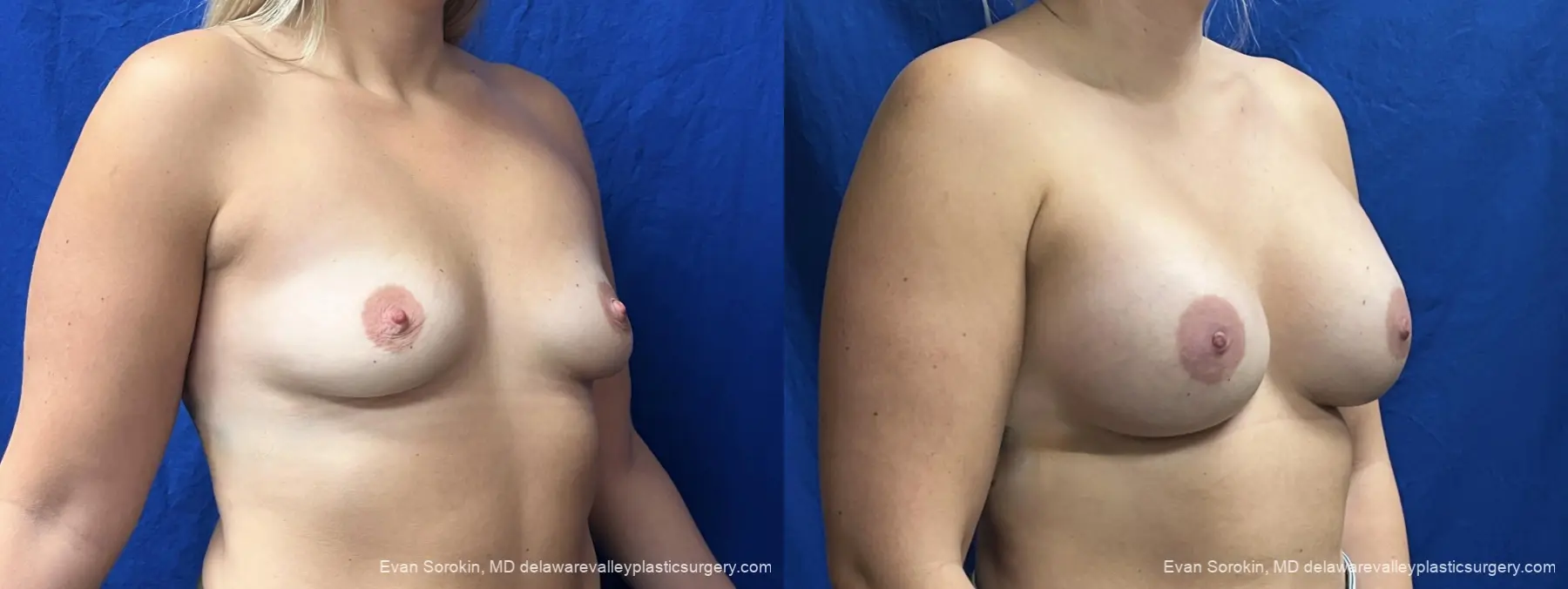 Breast Augmentation: Patient 326 - Before and After 2