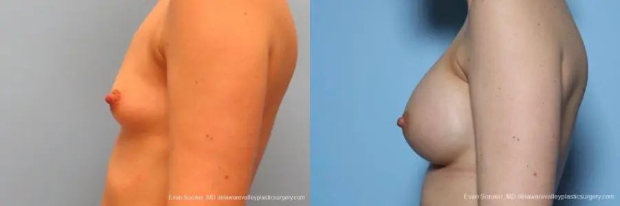 Philadelphia Breast Augmentation 8763 - Before and After 5