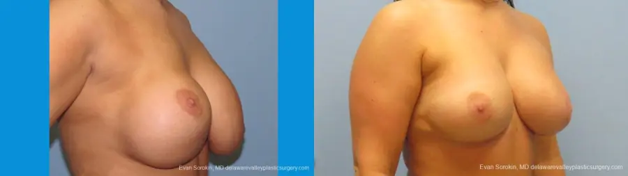 Philadelphia Breast Augmentation 10089 - Before and After 2