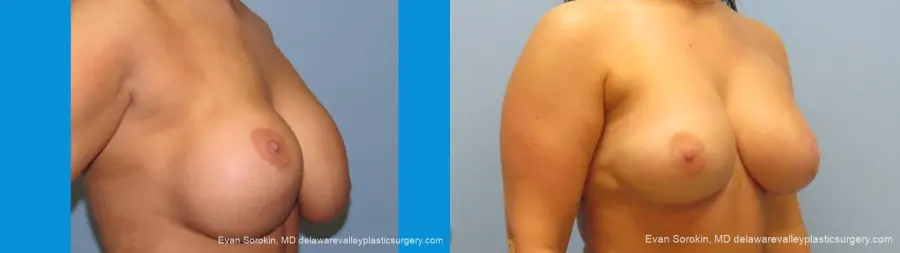 Philadelphia Breast Augmentation 10089 - Before and After 2
