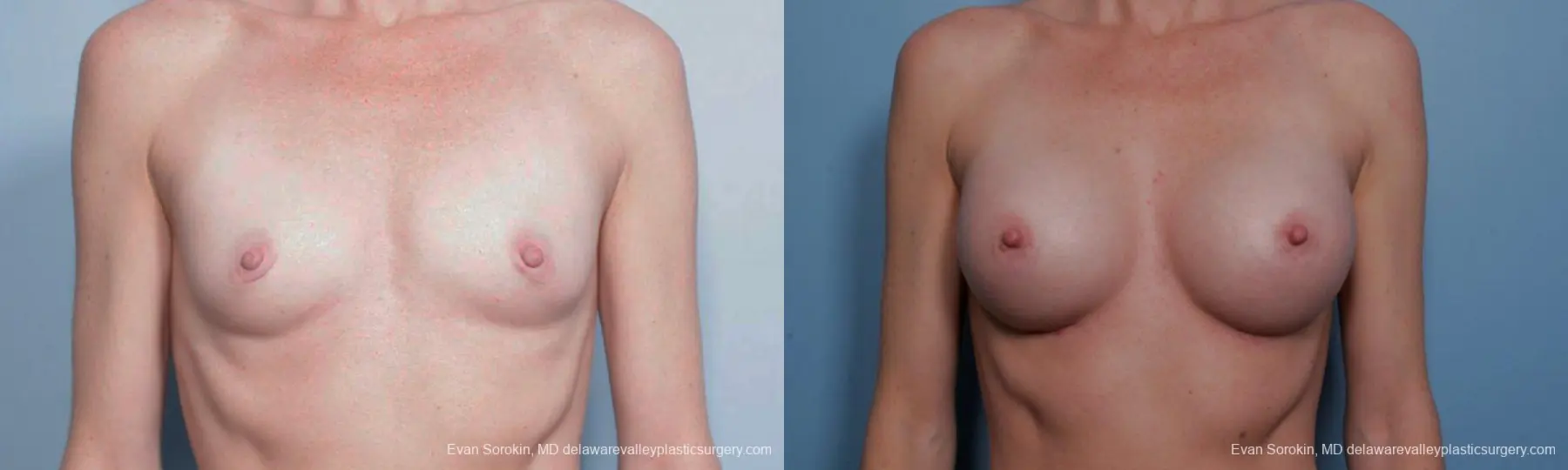 Philadelphia Breast Augmentation 9459 - Before and After 1