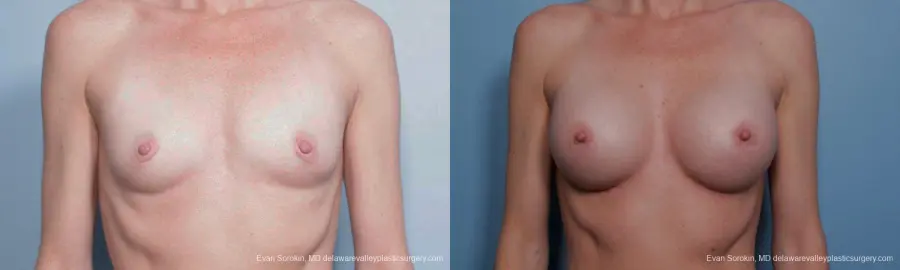 Philadelphia Breast Augmentation 9459 - Before and After 1