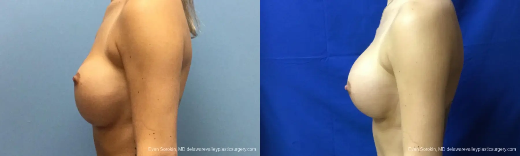 Philadelphia Breast Augmentation 10816 - Before and After 5