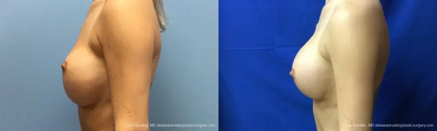 Philadelphia Breast Augmentation 10816 - Before and After 5